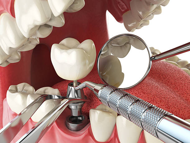 Best Knocked-Out Tooth Emergency  in Manana, HI